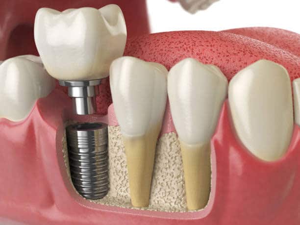 Cấy răng implant- trồng răng implant