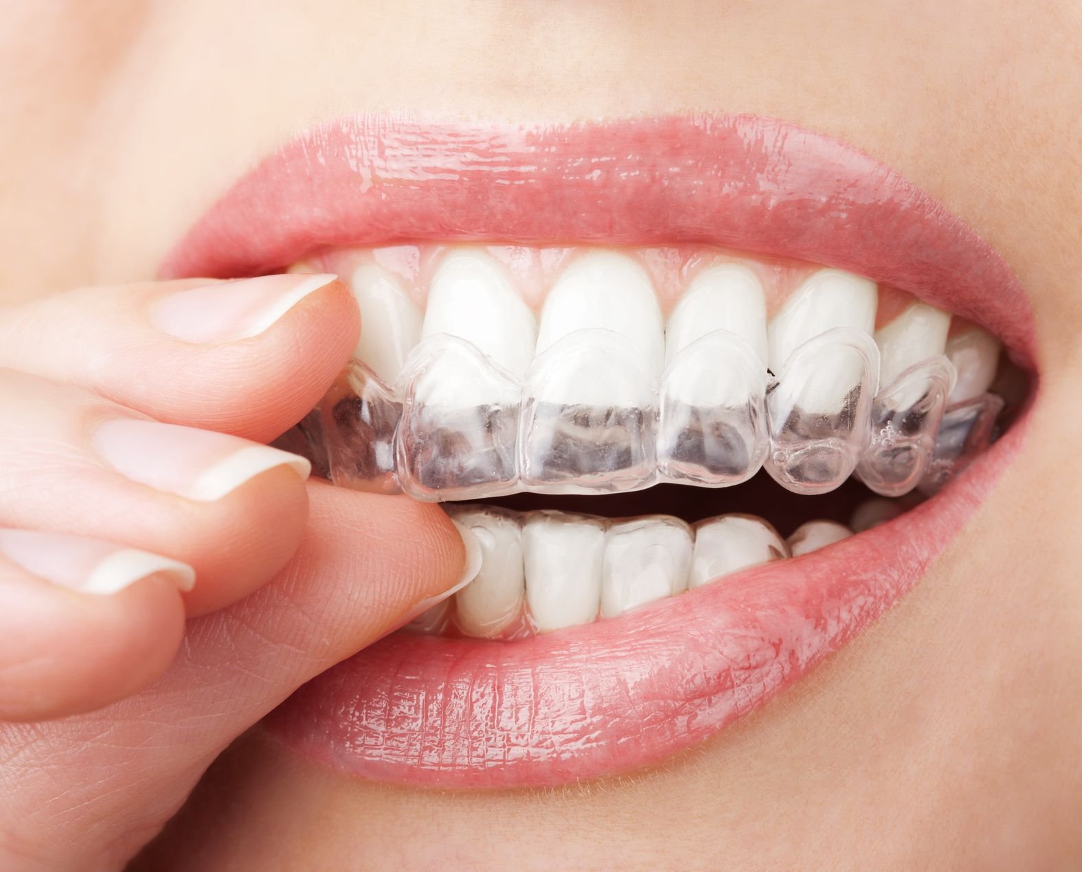 Niềng răng không mắc cài (Khay trong suốt) - Nha Khoa Quốc Tế Times Dental  105 Đào Tấn