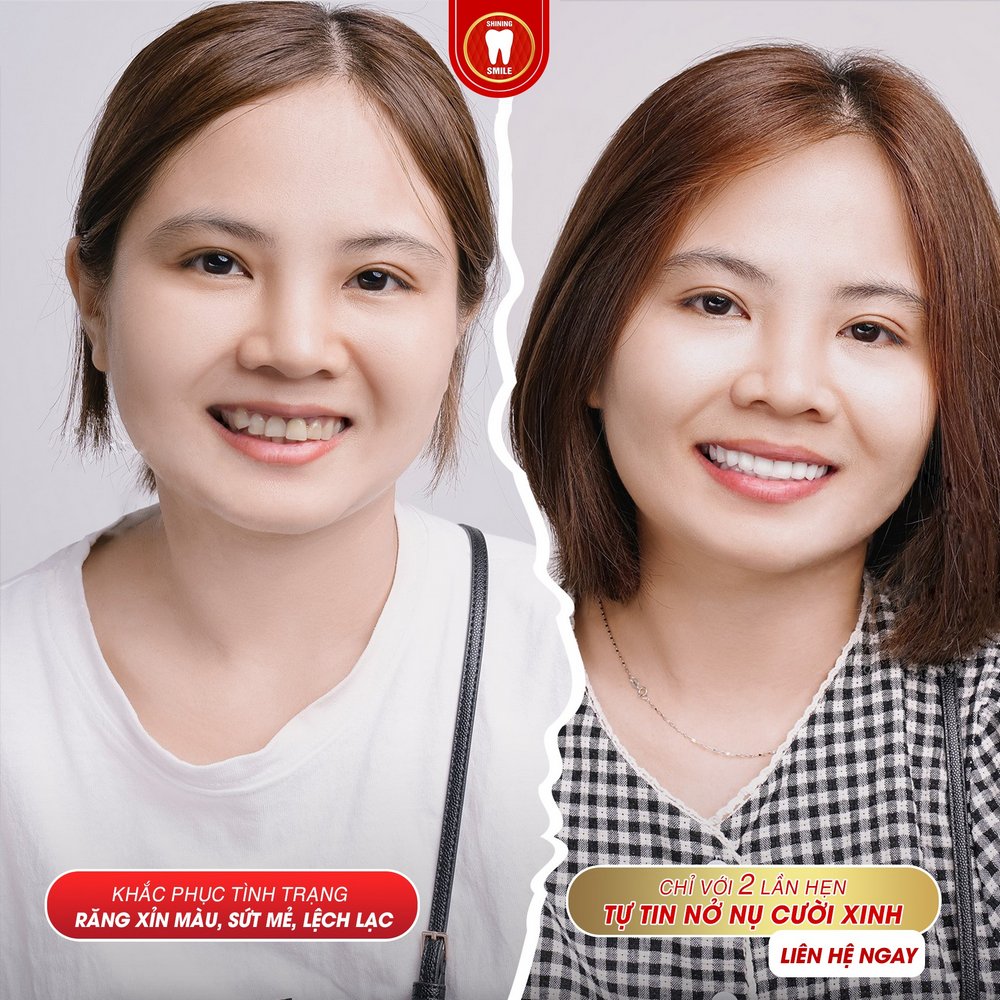 nieng rang 03