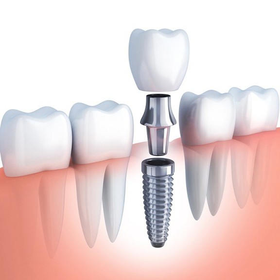 trong rang implant 1