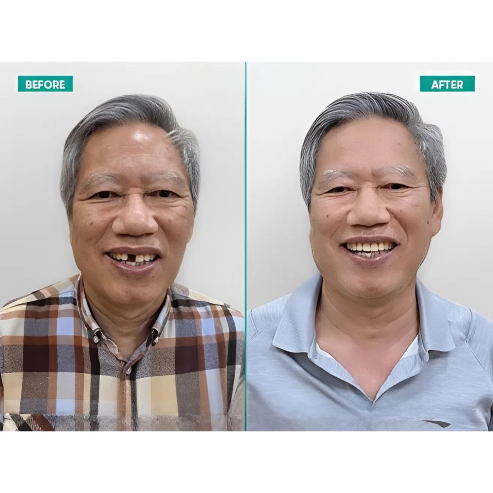 trong rang implant 2