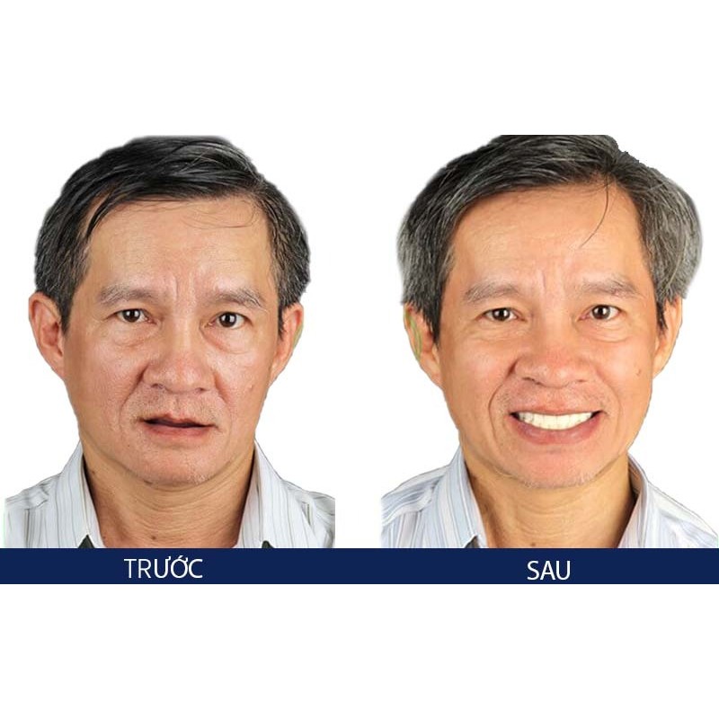 trong rang implant 3