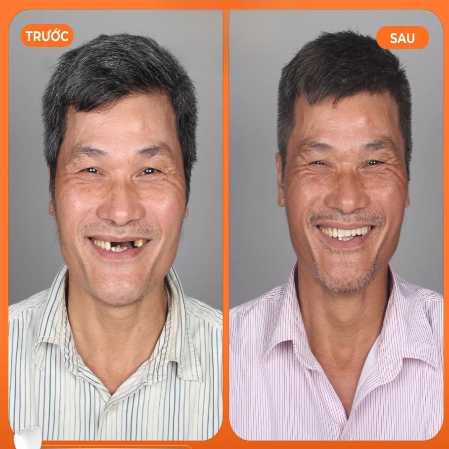 trong rang implant 4