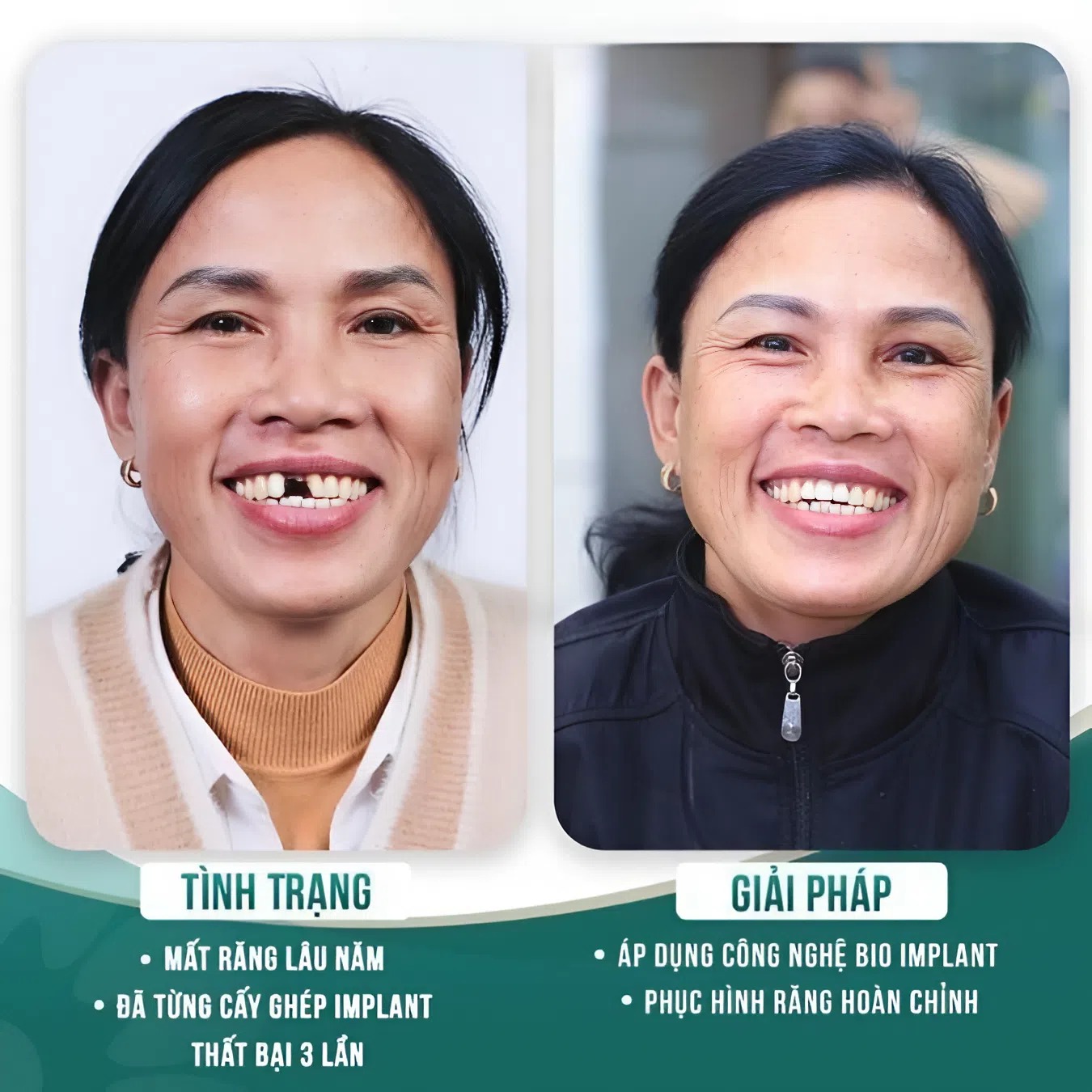 trong rang implant 5
