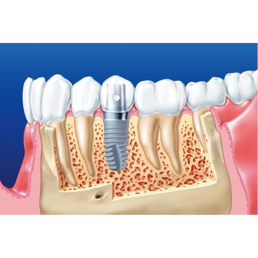 trong rang implant 6