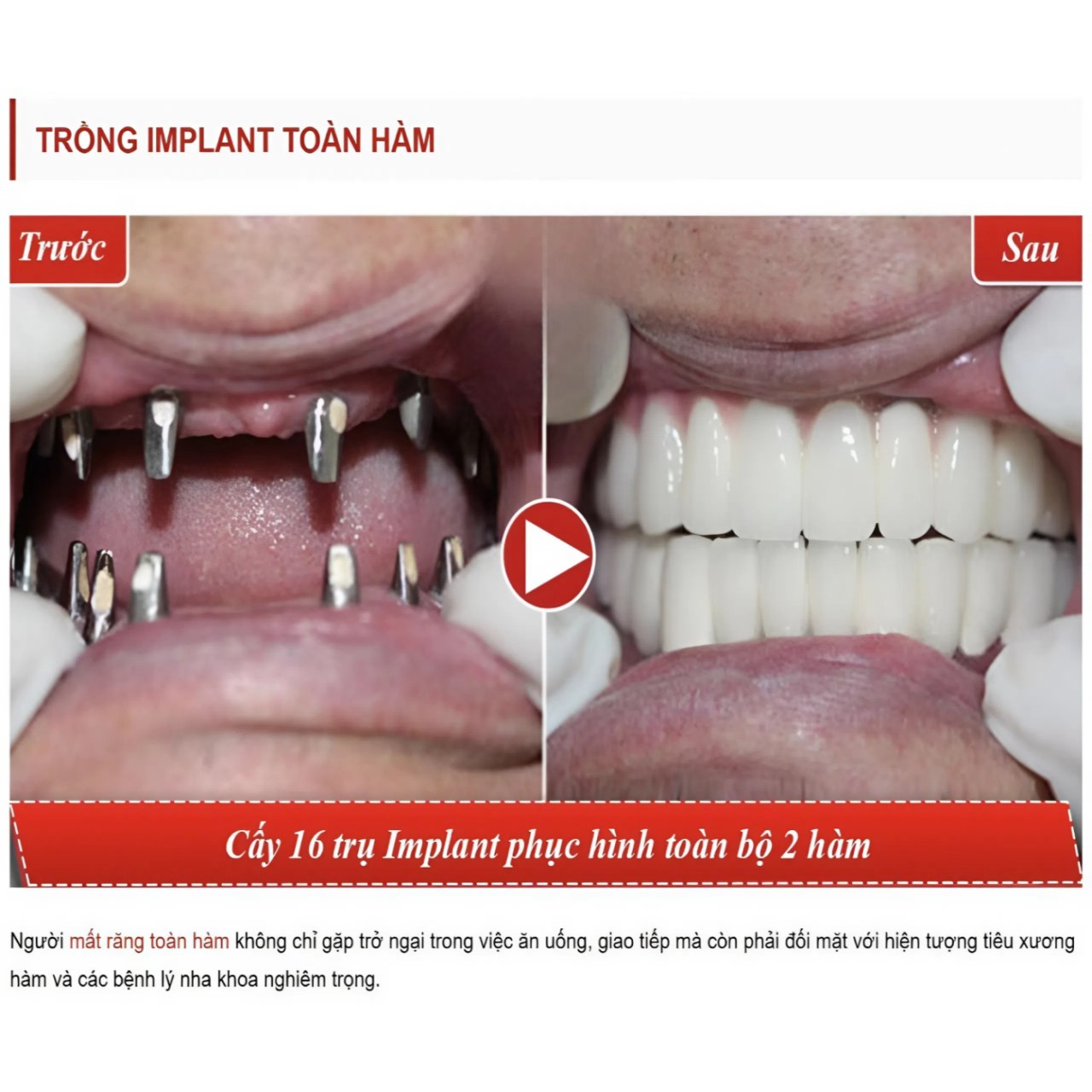trong rang implant 7