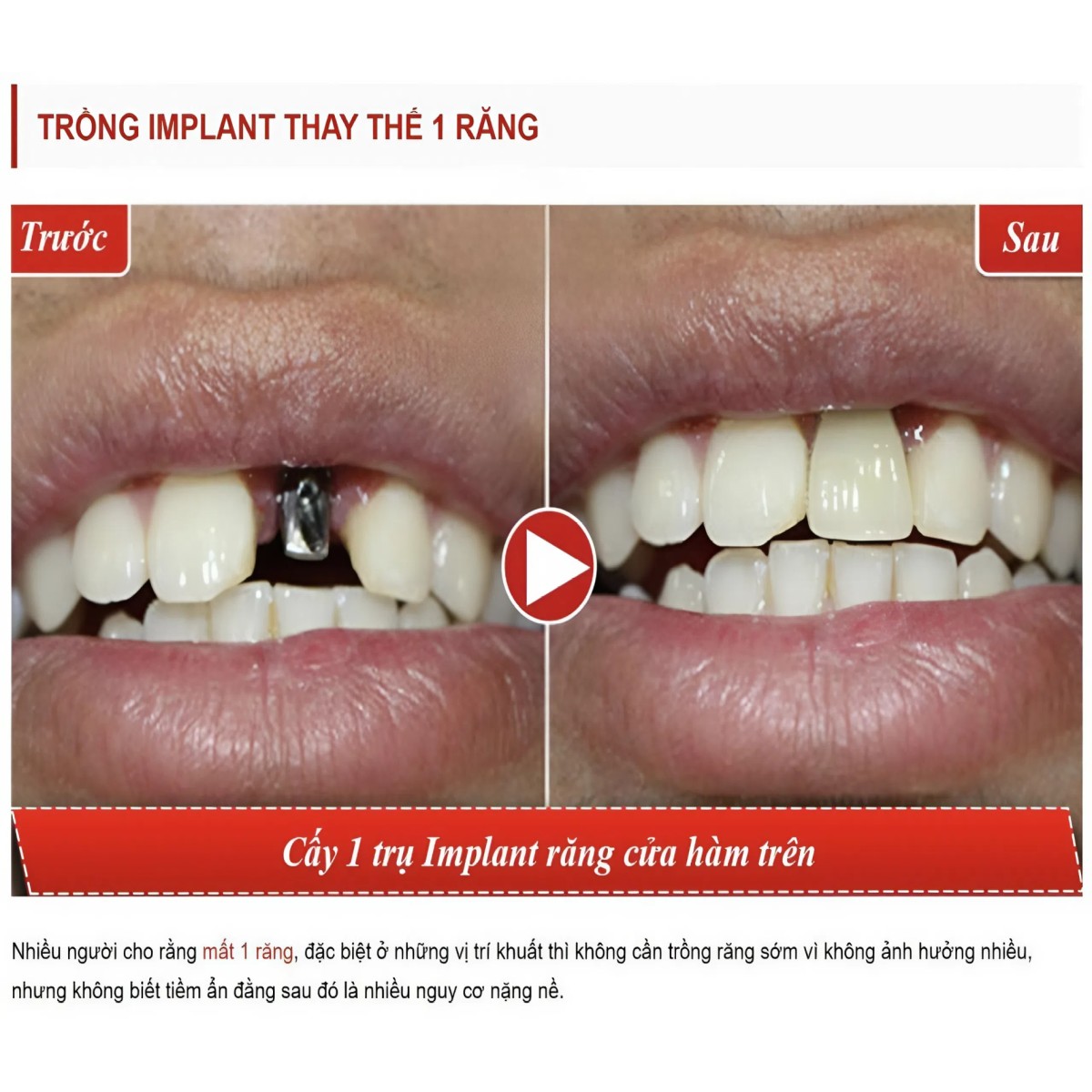 trong rang implant 8