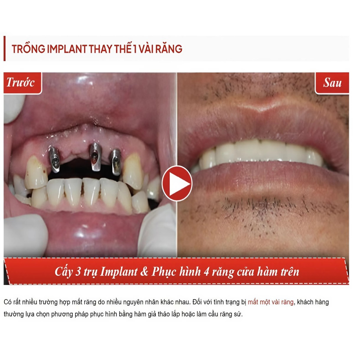trong rang implant 9